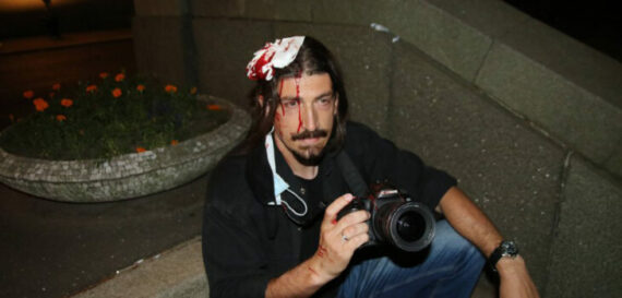 "Beta News Agency photojournalist Miloš Miškov injured in anti-covid demonstrations in Belgrade in July 2020 BETAPHOTO / Aleksandar Levajković "